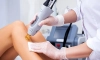 LASER EPILATION